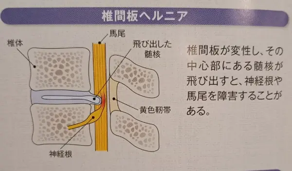 椎間板ヘルニア | 武蔵浦和ブロッサム鍼灸治療院・整体院